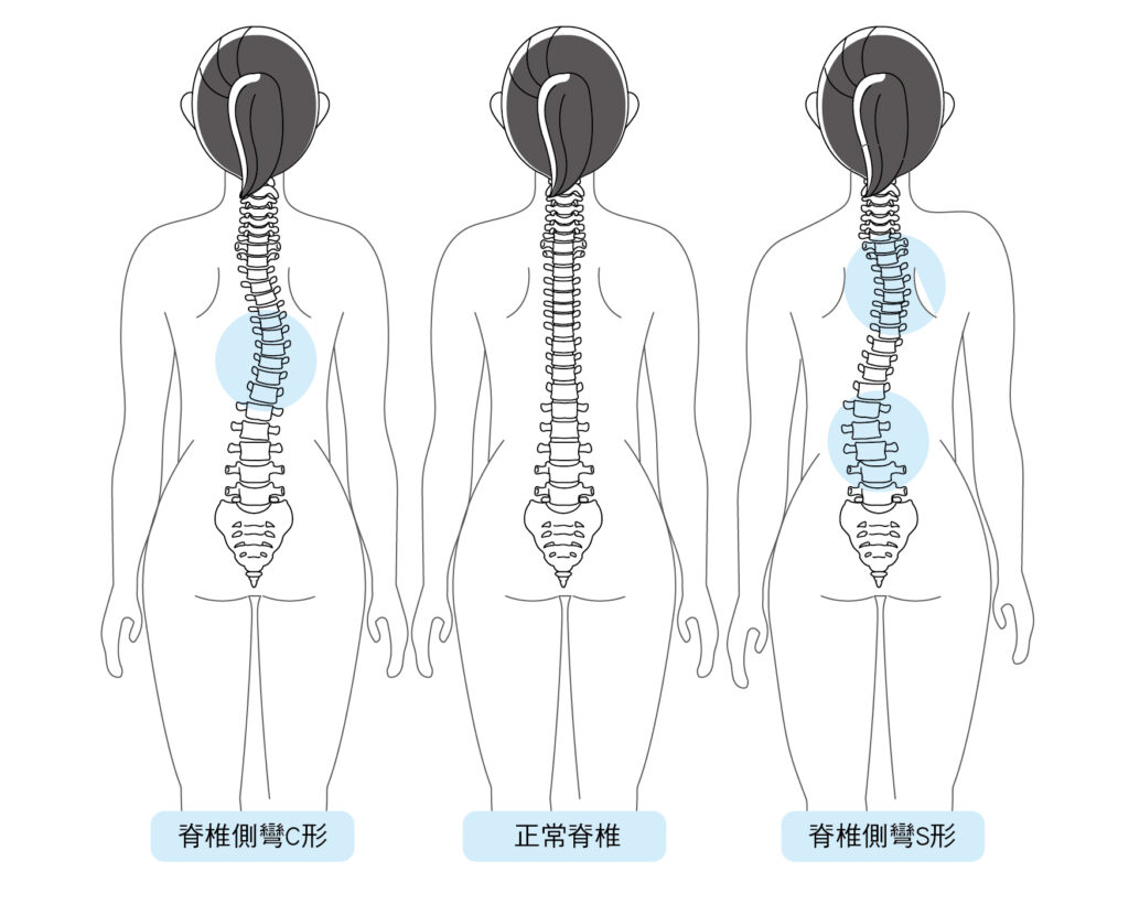 正常脊椎與脊椎側彎