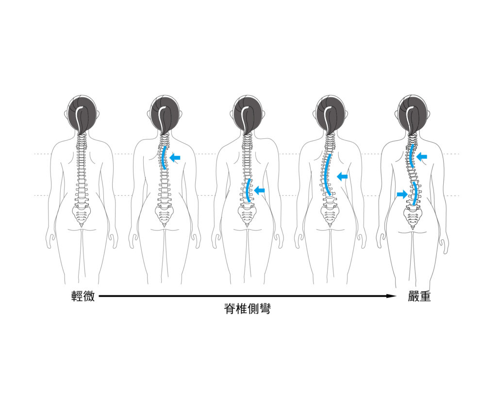 不同種類的脊椎側彎