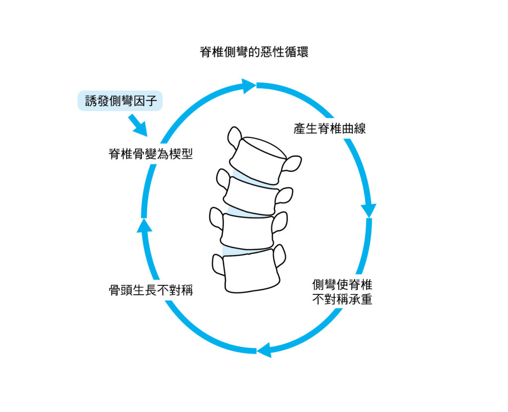 脊椎側彎惡性循環