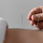 Acupuncture