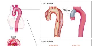 主動脈剝離是猝死常見原因，國內每年約有近2千人發病。(長庚醫院提供)