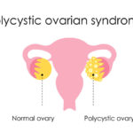 PCOS