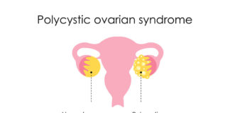 PCOS