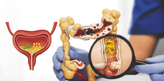 Diverticular Disease