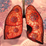 Lung Cancer