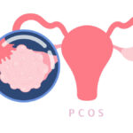 Pcos